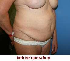 plastic-surgery-tummy-tuck